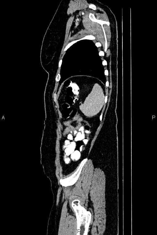 Carcinoma of uterine cervix (Radiopaedia 85861-101700 D 76).jpg