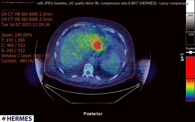 File:Cardiac lymphoma (Radiopaedia 38690-40871 Integrated PET-CT 20).jpg