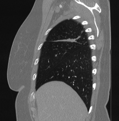 Cardiac sarcoidosis (Radiopaedia 74548-85534 Sagittal lung window 78).jpg