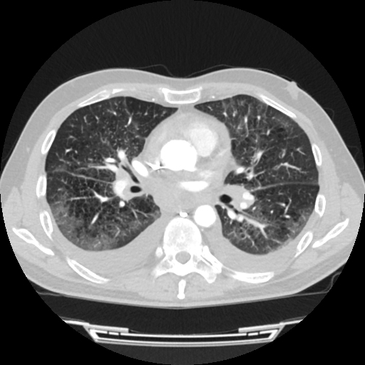 Cardiac tamponade (Radiopaedia 78607-91368 Axial lung window 43).jpg