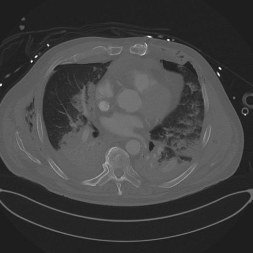 Cardiac trauma (Radiopaedia 32874-33858 Axial bone window 50).jpg