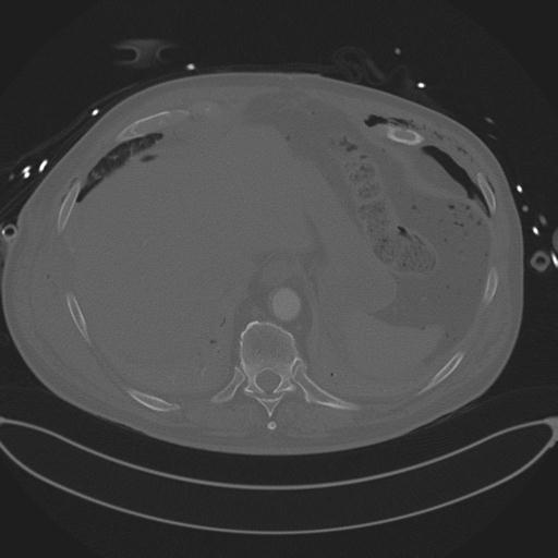 Cardiac trauma (Radiopaedia 32874-33858 Axial bone window 77).jpg