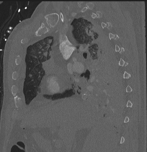 Cardiac trauma (Radiopaedia 32874-33858 Sagittal bone window 67).jpg