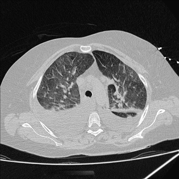 Cardiogenic pulmonary edema (Radiopaedia 29213-29609 Axial lung window 26).jpg