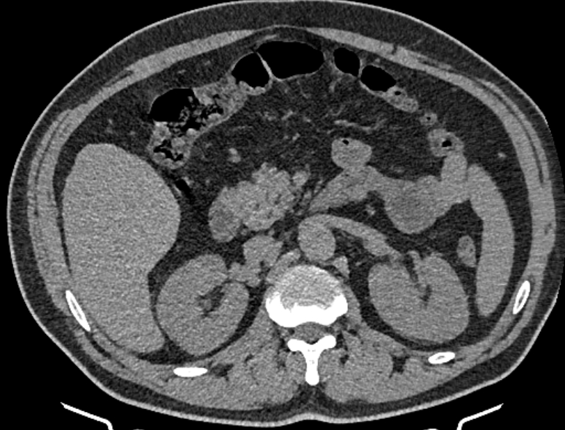 Cardiogenic pulmonary edema (Radiopaedia 68180-77678 Axial non-contrast 73).jpg