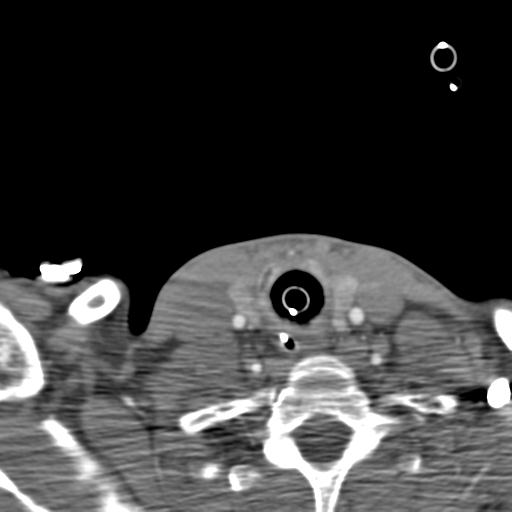 Carotid arterial dissection (Radiopaedia 30001-30548 B 35).jpg