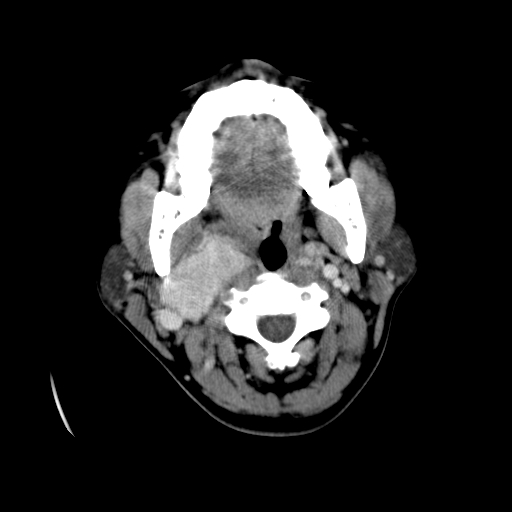 File:Carotid body tumor (Radiopaedia 27890-28124 A 11).jpg