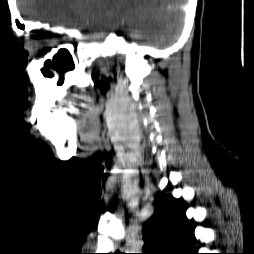 File:Carotid body tumor (Radiopaedia 27890-28124 C 16).jpg