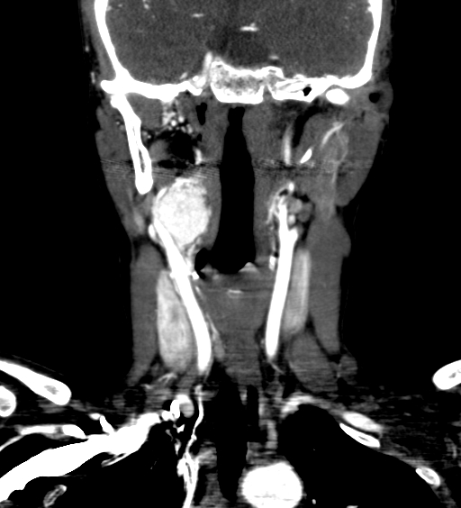 File:Carotid body tumor (Radiopaedia 39845-42300 C 29).jpg