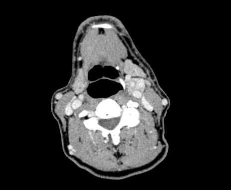 Carotid body tumor (Radiopaedia 61750-69757 Axial Post contrast 54).jpg