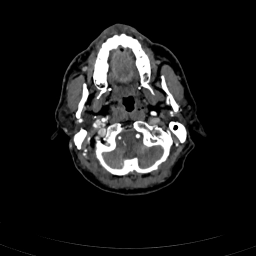 Carotid body tumor (Radiopaedia 83615-98727 A 31).jpg