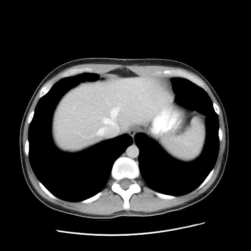 Castleman disease with fibrous pseudotumor in the abdomen (Radiopaedia 77296-89373 A 16).jpg