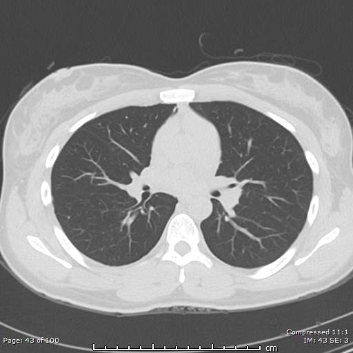 Catamenial pneumothorax (Radiopaedia 54382-60600 Axial non-contrast 43).jpg