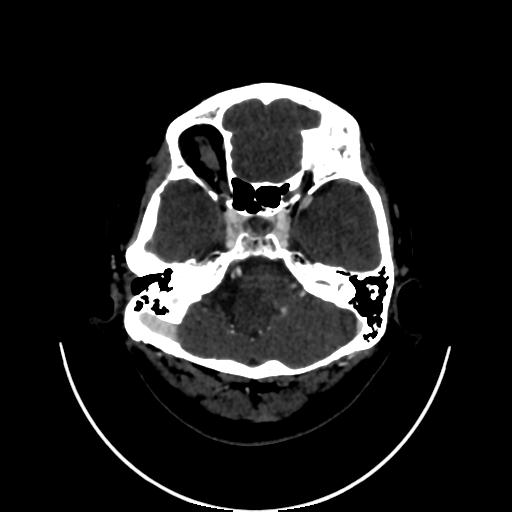 Cavernoma with developmental venous anomaly (Radiopaedia 22470-22506 C 24).jpg
