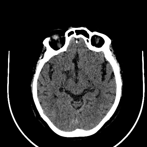 Cavernous hemangioma of the cerebellar falx (Radiopaedia 73025-83723 Axial non-contrast 59).jpg