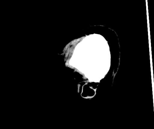 Cavernous hemangioma of the cerebellar falx (Radiopaedia 73025-83723 B 308).jpg