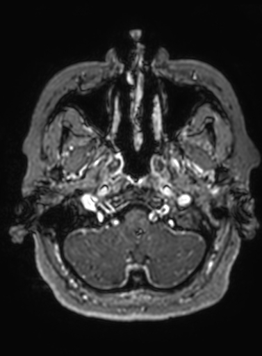 File:Cavernous hemangioma of the cerebellar falx (Radiopaedia 73025-83724 Axial T1 C+ 298).jpg