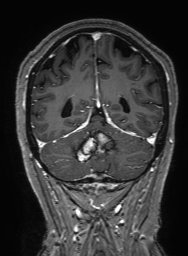 Cavernous hemangioma of the cerebellar falx (Radiopaedia 73025-83724 Coronal T1 C+ 282).jpg