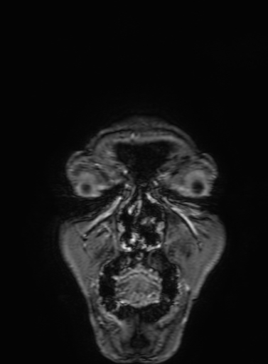 Cavernous hemangioma of the cerebellar falx (Radiopaedia 73025-83724 Coronal T1 C+ 9).jpg