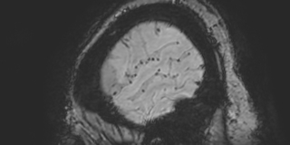 Cavernous hemangioma of the cerebellar falx (Radiopaedia 73025-83724 Sagittal BOLD 188).jpg