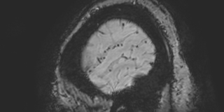 File:Cavernous hemangioma of the cerebellar falx (Radiopaedia 73025-83724 Sagittal BOLD 190).jpg