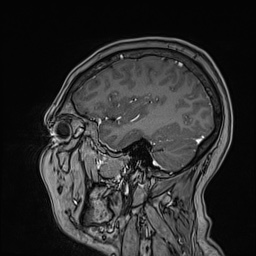 Cavernous sinus meningioma (Radiopaedia 63682-72367 Sagittal T1 C+ 128).jpg
