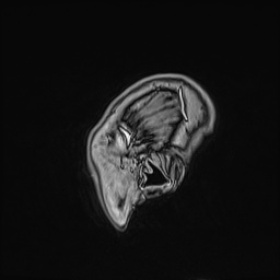Cavernous sinus meningioma (Radiopaedia 63682-72367 Sagittal T1 C+ 162).jpg