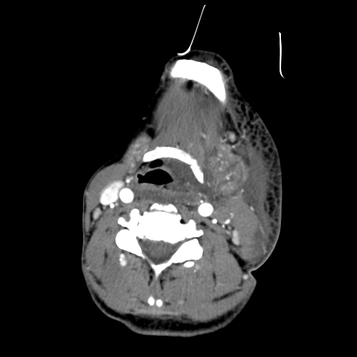 File:Cavernous sinus thrombosis (Radiopaedia 10619-11078 A 20).jpg