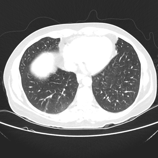 File:Cavitating lung mass - squamous cell carcinoma (Radiopaedia 48047-52854 Axial lung window 35).png