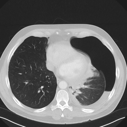 File:Cavitating pneumonia complicated by pneumothorax (Radiopaedia 48149-52994 Axial lung window 46).png