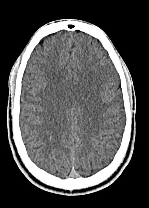 Cavum septum pellucidum and cavum vergae (Radiopaedia 77797-90060 Axial Brain Window 70).jpg