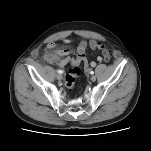 Cecal mass causing appendicitis (Radiopaedia 59207-66531 A 71).jpg