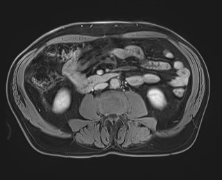 Cecal mass causing appendicitis (Radiopaedia 59207-66532 J 75).jpg