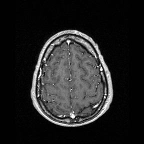 Central-variant posterior reversible encephalopathy syndrome (PRES) (Radiopaedia 43880-47358 Axial T1 C+ 143).jpg