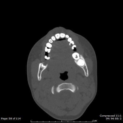 File:Central giant cell granuloma (Radiopaedia 45612-49754 Axial bone window 29).jpg