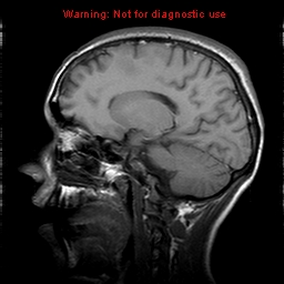 File:Central nervous system vasculitis (Radiopaedia 8410-9235 Sagittal T1 14).jpg