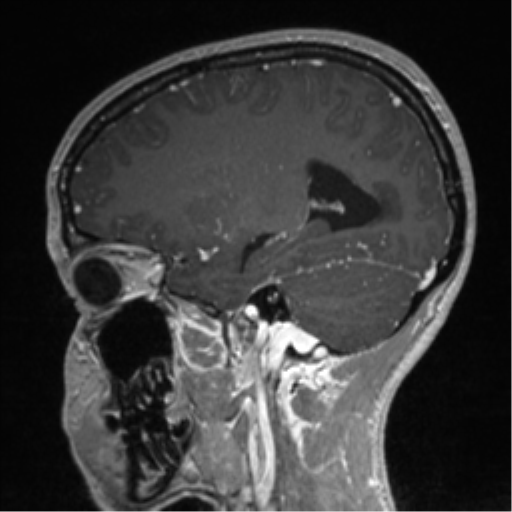 Central neurocytoma (Radiopaedia 37664-39557 Sagittal T1 C+ 65).png
