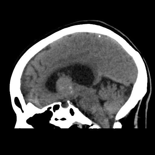 File:Central neurocytoma (Radiopaedia 65317-74346 C 28).png