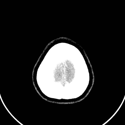 Central neurocytoma (Radiopaedia 84497-99871 Axial non-contrast 51).jpg