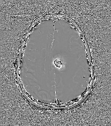 File:Central neurocytoma (Radiopaedia 84497-99872 Axial 51).jpg