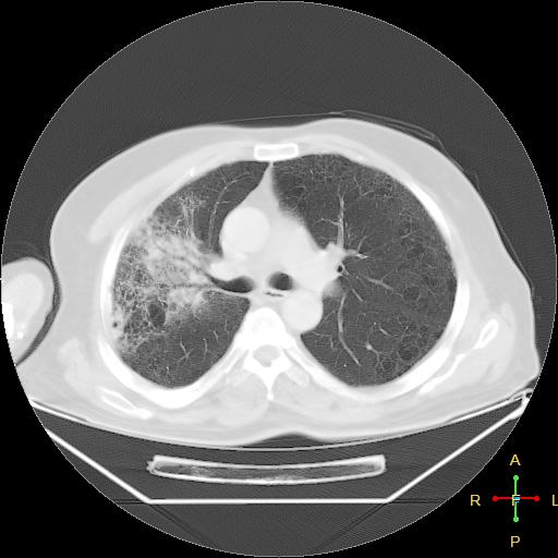 File:Centrilobular emphysema - with superimposed infection (Radiopaedia 24389-24683 lung window 12).jpg