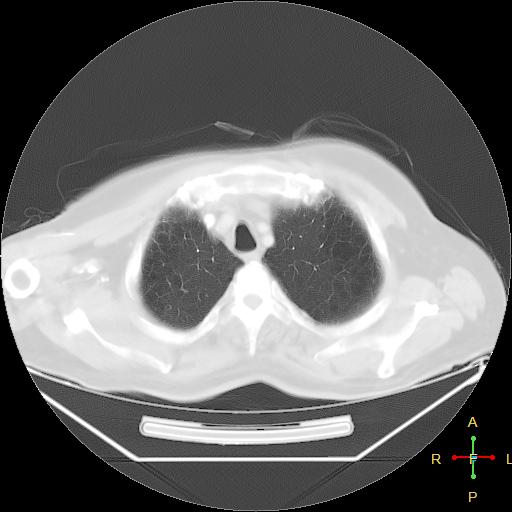File:Centrilobular emphysema - with superimposed infection (Radiopaedia 24389-24683 lung window 4).jpg