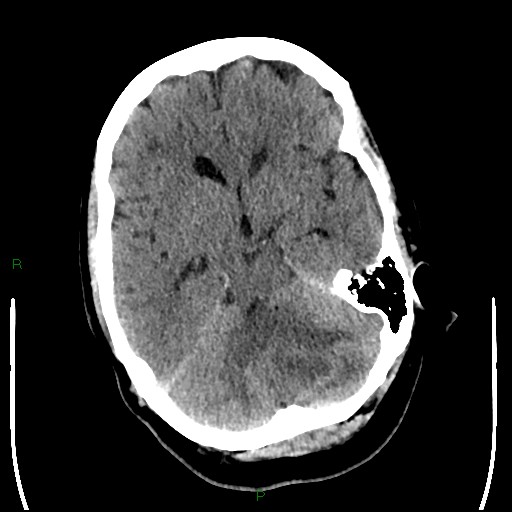 File:Cerebellar abscess (Radiopaedia 78135-90671 Axial non-contrast 40).jpg