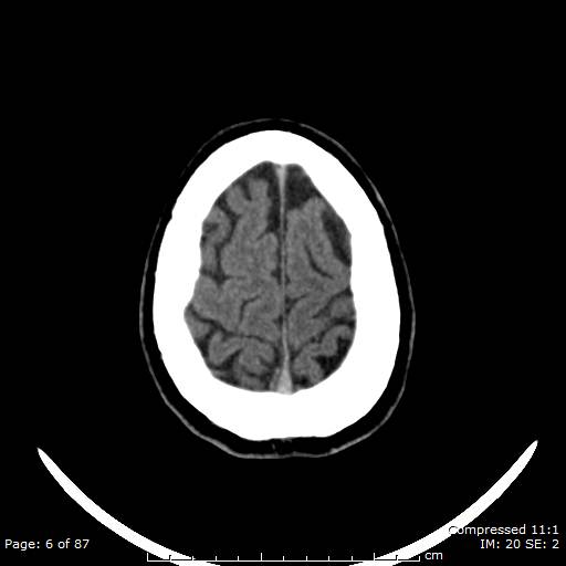 Cerebellar hemangioblastoma (Radiopaedia 52360-58258 Axial non-contrast 6).jpg