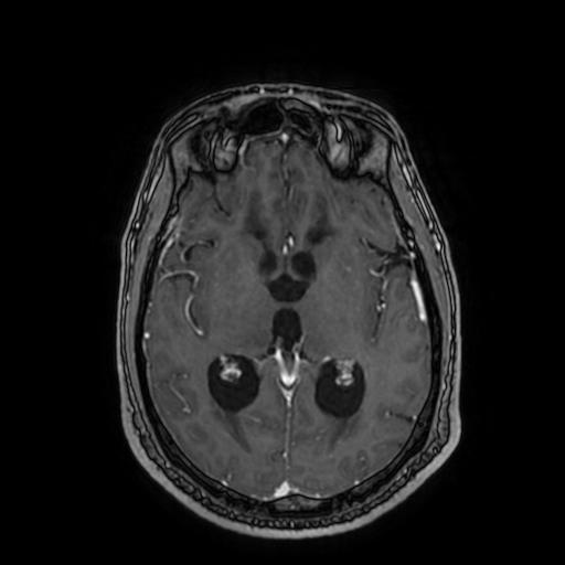 File:Cerebellar hemangioblastoma (Radiopaedia 88055-104622 Axial T1 C+ 95).jpg