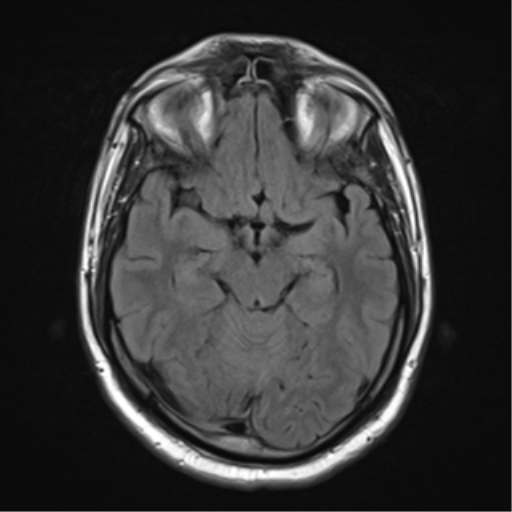 File:Cerebellar hemangioblastomas and pituitary adenoma (Radiopaedia 85490-101176 Axial FLAIR 12).png