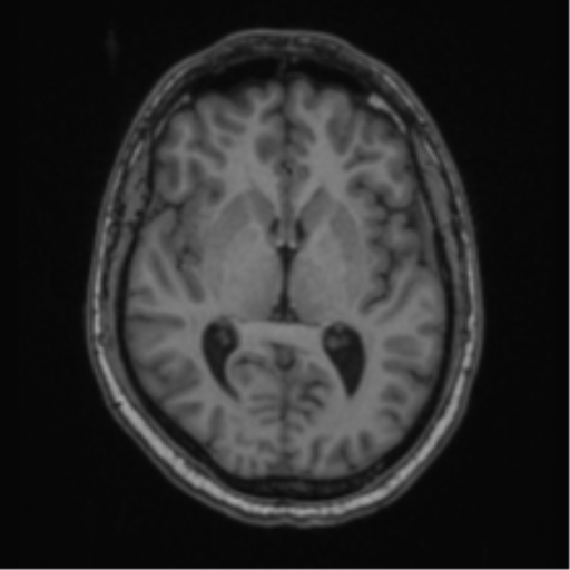 Cerebellar hemangioblastomas and pituitary adenoma (Radiopaedia 85490-101176 Axial T1 38).png