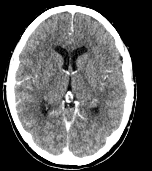 Cerebellar metastases - colorectal adenocarcinoma (Radiopaedia 40947-43652 Axial C+ 29).png