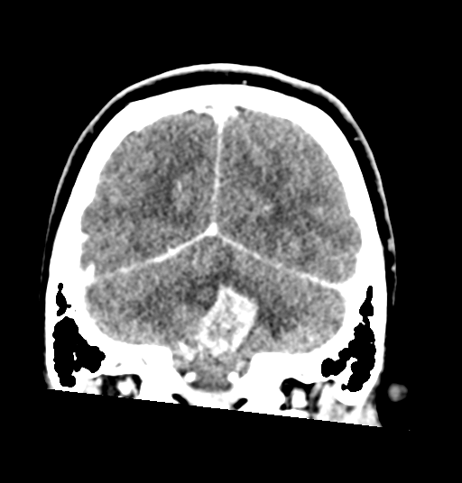 Cerebellar metastases - colorectal adenocarcinoma (Radiopaedia 40947-43652 Coronal C+ 71).png
