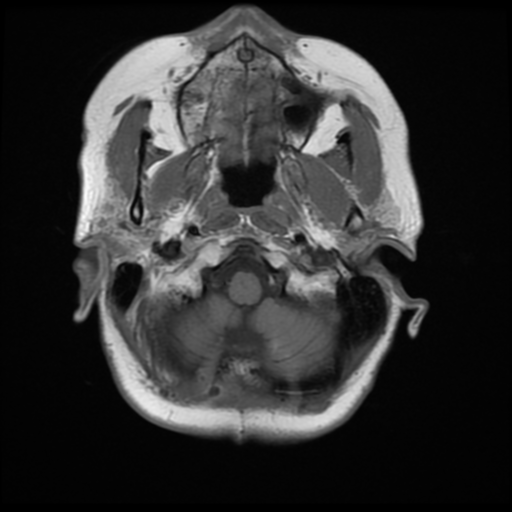 File:Cerebellar metastasis (cystic appearance) (Radiopaedia 41395-44268 Axial T1 3).png